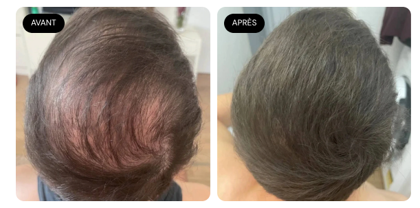 Camouflage capillaire